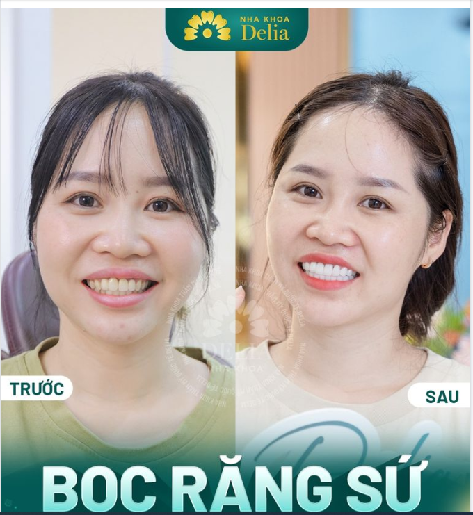 Chị Nhung Phạm hài lòng tuyệt đối với kết quả bọc răng sứ tại Delia!
