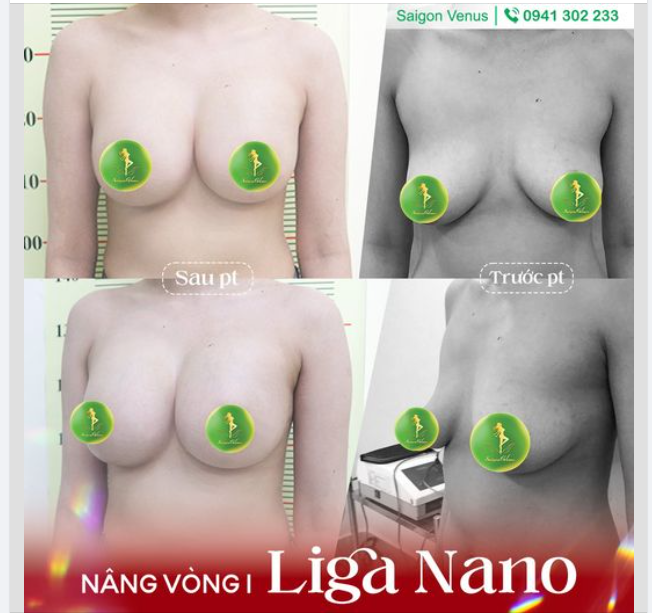 GIẢI PHÁP LIGA NANO SIÊU NHẸ NHÀNG CHO KHÁCH HÀNG SỢ ĐAU