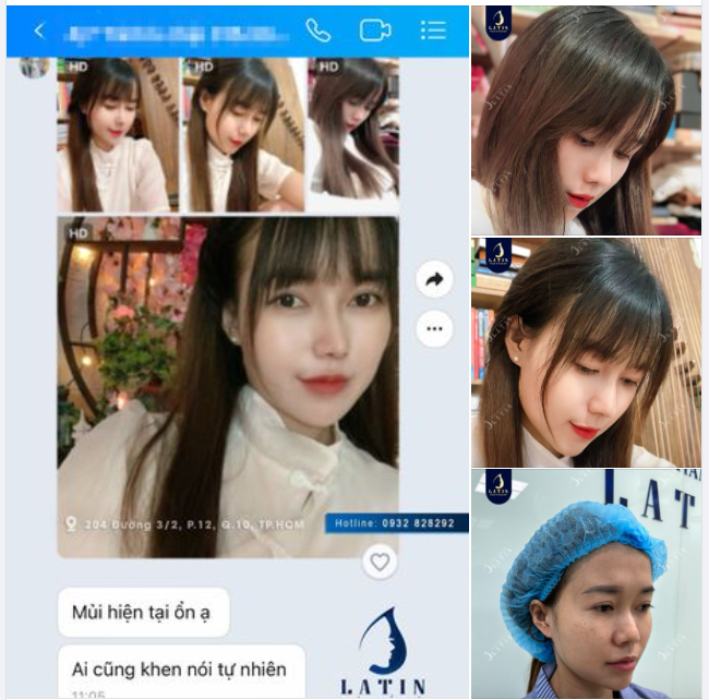 Feedback khách nâng mũi gần 1 năm nhà Latin đây