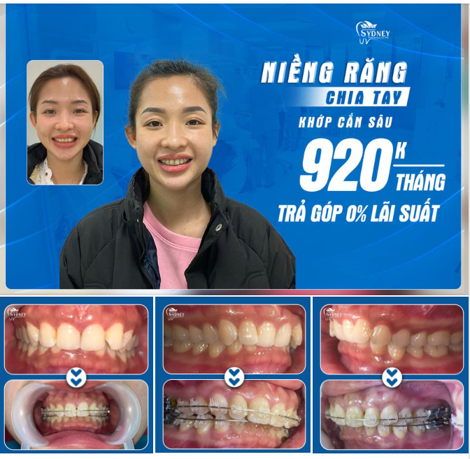 NIỀNG RĂNG KHỚP CẮN SÂU THAY ĐỔI NHƯ THẾ NÀO?