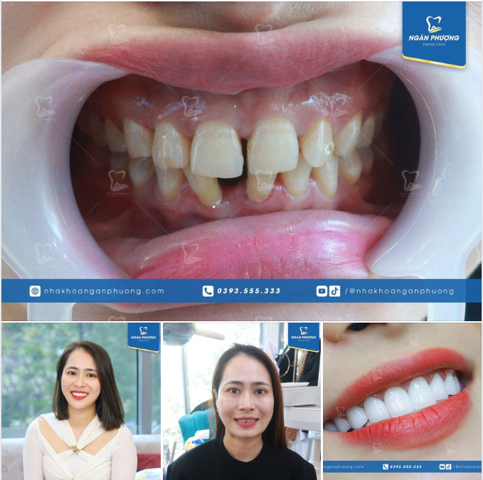 Răng thưa khoảng lớn có thể làm sứ để khắc phục được không?