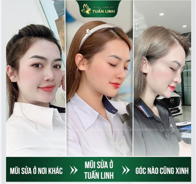 Sự khác biệt nằm ở địa chỉ bạn chọn để nâng mũi!!