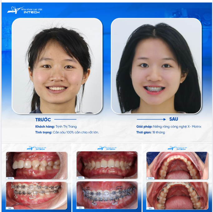 NỮ SINH 2K TÌM LẠI NỤ CƯỜI TỰ TIN NHỜ NIỀNG RĂNG BẰNG CÔNG NGHỆ MỚI NHẤT