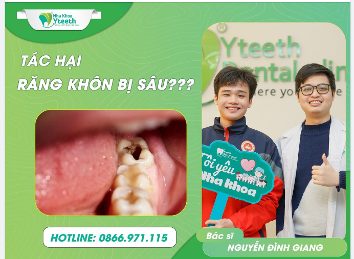 Răng khôn bị sâu? ảnh hưởng răng cấm số 7