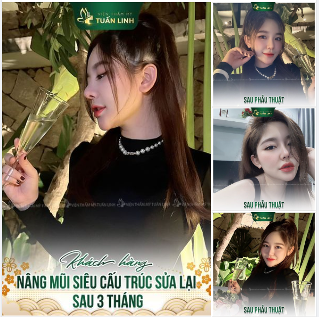 Thay đổi tích cực sau 3 tháng khắc phục mũi hỏng sau phẫu thuật!!