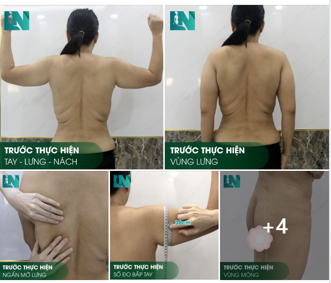 HÌNH ẢNH TRƯỚC KHI THỰC HIỆN HÚT MỠ TẠO DÁNG TAY - LƯNG - NÁCH VÀ CẤY MỠ MÔNG CHỊ KHÁCH HÀNG 8X