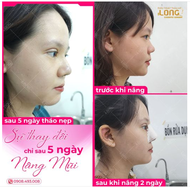 MŨI ĐẸP ĐÓN NĂM THÌN - NGHÌN NGƯỜI YÊU THÍCH