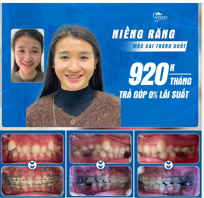 NIỀNG RĂNG, CẤY IMPLANT CẢI THIỆN THẨM MỸ NỤ CƯỜI