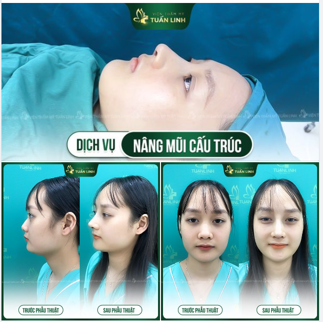 Trải nghiệm NÂNG MŨI KHÔNG ĐAU, KHÔNG SƯNG BẦM tại Tuấn Linh!!
