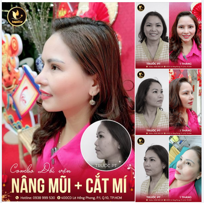 COMBO ĐỔI VẬN. Trọn vẹn sau 1 tháng thay đổi diện mạo với combo NÂNG MŨI CẤU TRÚC kết hợp CẮT MÍ MẮT.