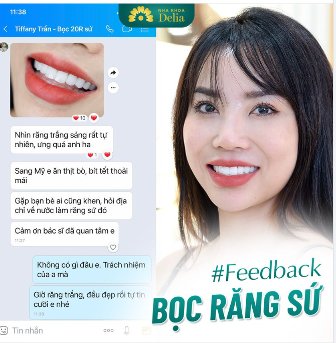 Đẹp quá! Feedback từ chị Tiffany Trần sau 1 năm bọc 20 răng sứ Orodent Bleach tại Nha khoa Delia