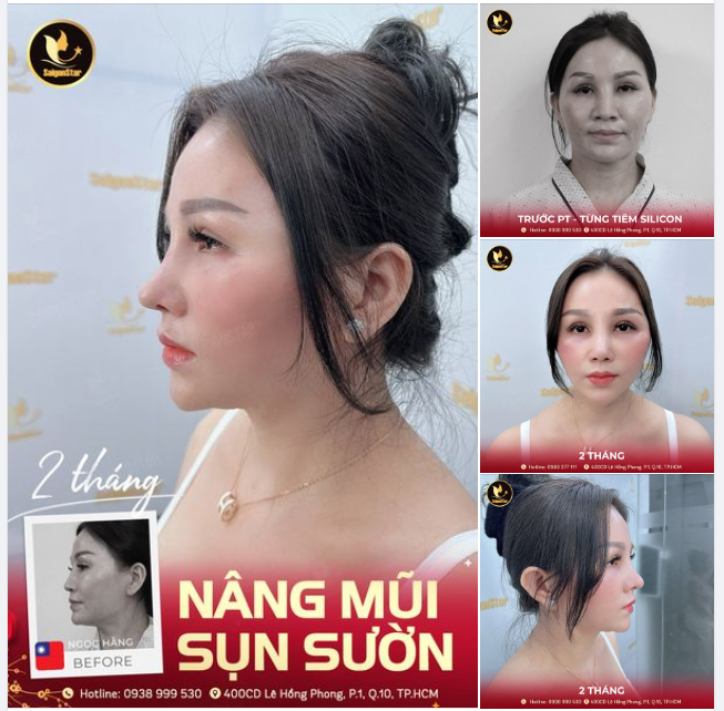 SAU 2 THÁNG NÂNG MŨI SỤN SƯỜN