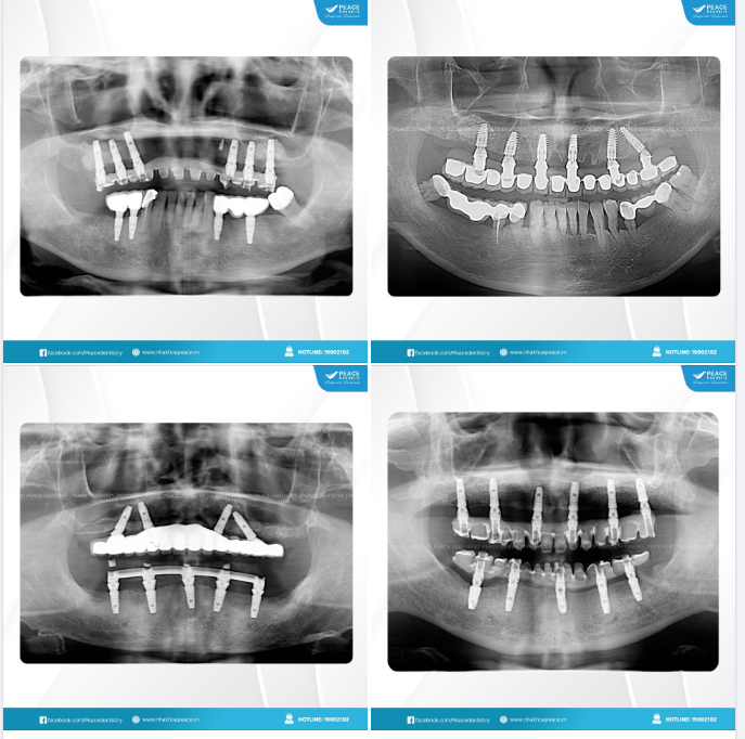 CẤY GHÉP IMPLANT PHỤC HÌNH TỨC THÌ: