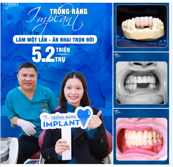 TRỒNG RĂNG IMPLANT RĂNG CỬA CẢI THIỆN THẨM MỸ, ĂN NHAI