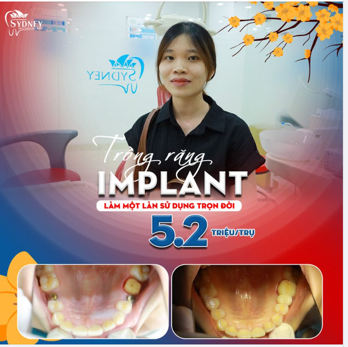 TRỒNG RĂNG ĐÓN TẾT – NIỀM VUI TRỌN VẸN