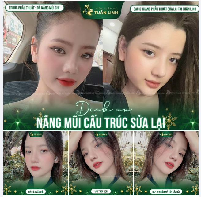 Đã từng nâng mũi chỉ nhưng bị co rút, biến chứng, dáng mũi to thô...Cô nàng 9X T.H đã chọn nâng mũi cấu trúc sửa lại tại Tuấn Linh.