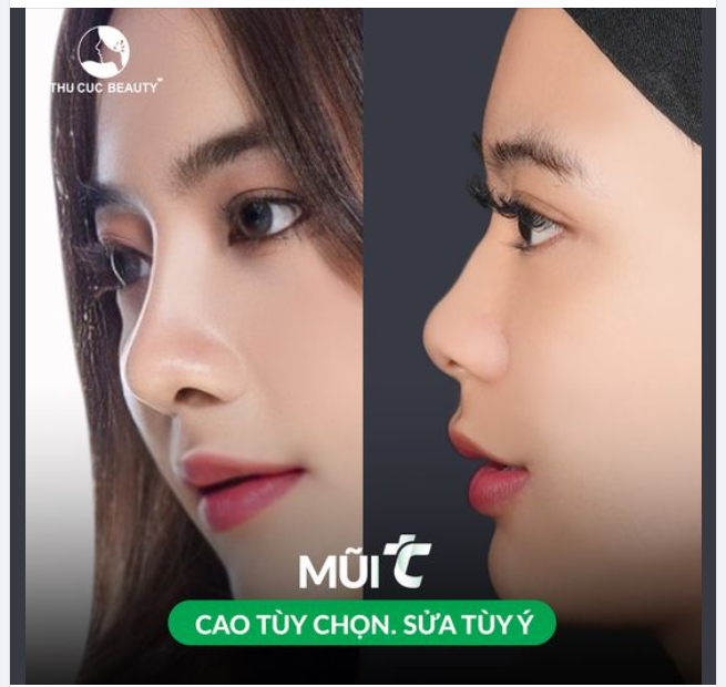 Nâng mũi Thu Cúc Không đau, đẹp chuẩn tỷ lệ vàng