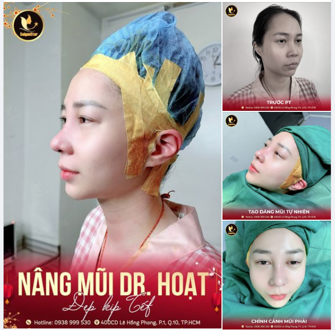 NÂNG MŨI DR. HOẠT – ĐẸP KỊP TẾT