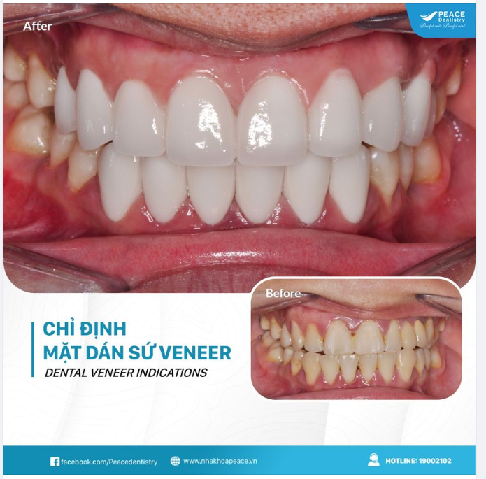 VENEER PHÙ HỢP CHO TÌNH TRẠNG RĂNG NÀO?