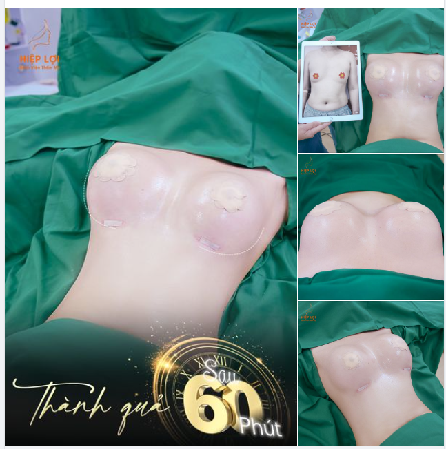 NÂNG NGỰC ĐÓN TẾT, THẢ SỨC KHOE DÁNG XINH​​​​​​​ - Chỉ sau 60 PHÚT