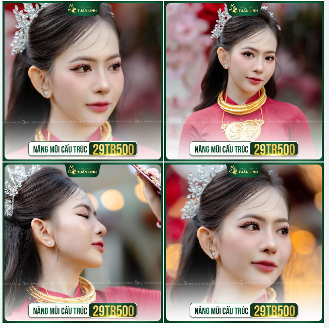 Mũi cấu trúc siêu xịn xò chưa bao giờ Tuấn Linh sale nhiều như thế đâu ạ!