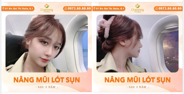 Giả vờ ngắm trời, ngắm mây qua khung máy bay thế thôi, chứ thật ra là đang flex chiếc mũi lót sụn đã hơn 3 năm đó thôi