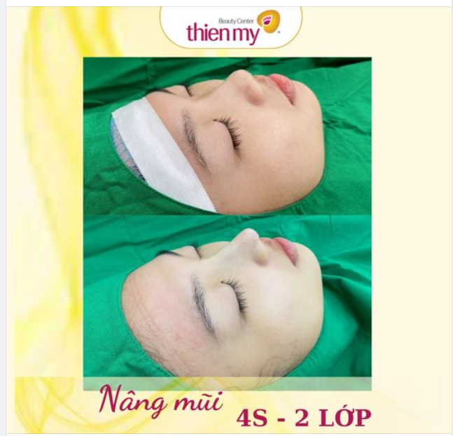 Những lưu ý nâng mũi bọc sụn 4S - 2 lớp: