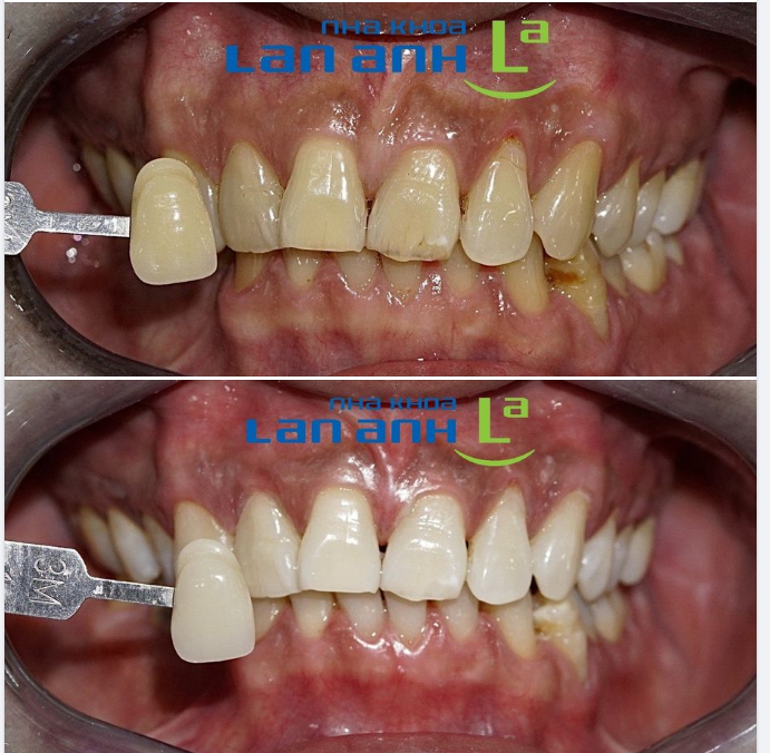 Ngay cả khi răng bạn không được đẹp, thì việc tẩy trắng để răng có màu sáng hơn cũng giúp cải thiện được thẩm mỹ phần nào!