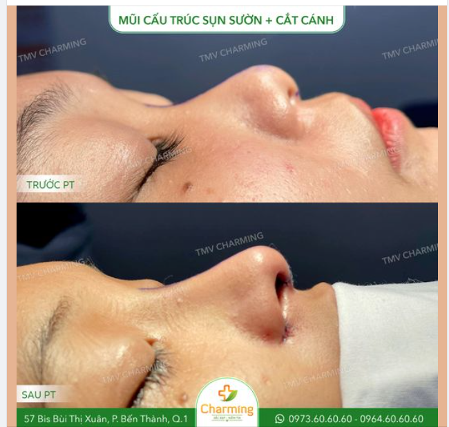 Sau khi thực hiện phương pháp nâng mũi cấu trúc sụn sườn và cắt cánh mũi tại Charming, vẻ ngoài của nàng khách thay đổi hoàn toàn.