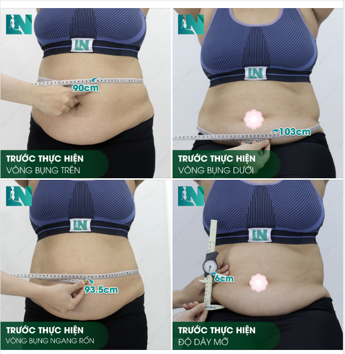 HÌNH ẢNH TRƯỚC KHI THỰC HIỆN HÚT MỠ TẠO DÁNG BỤNG - EO - HÔNG CHO CHỊ KHÁCH SINH NĂM 1982