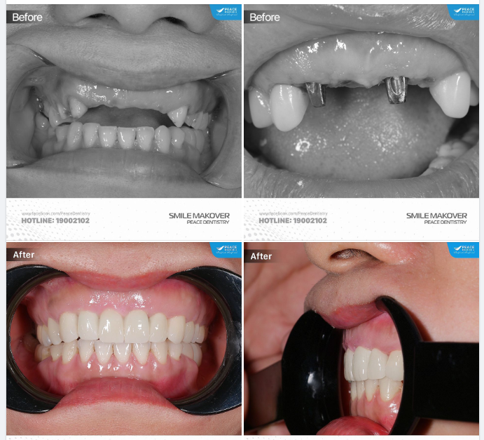 Ca lâm sàng implant & phục hình răng sứ giúp khôi phục trọn vẹn chức năng ăn nhai, nâng cao thẩm mỹ nụ cười và bảo vệ sức khỏe răng miệng.
