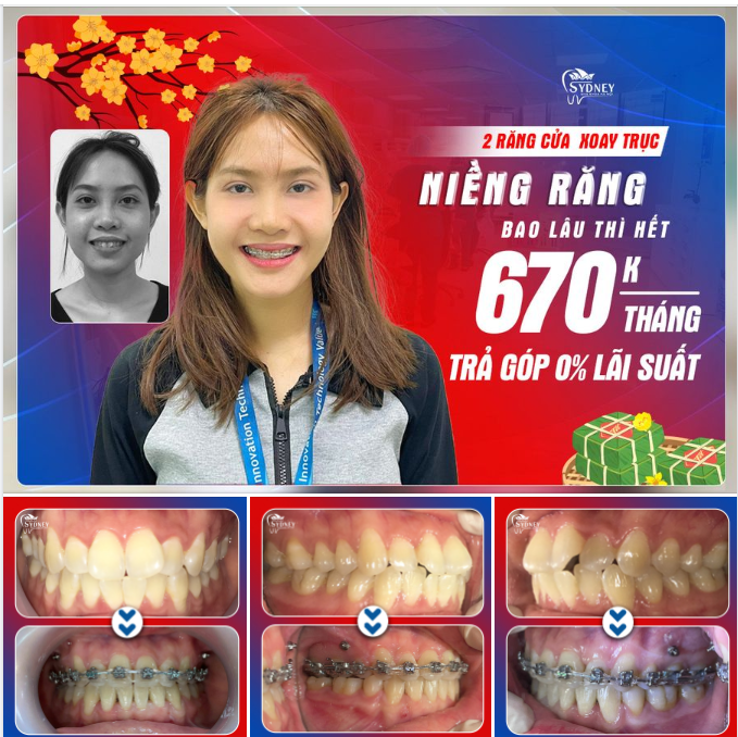 NIỀNG RĂNG KHẮC PHỤC RĂNG CỬA XOAY TRỤC