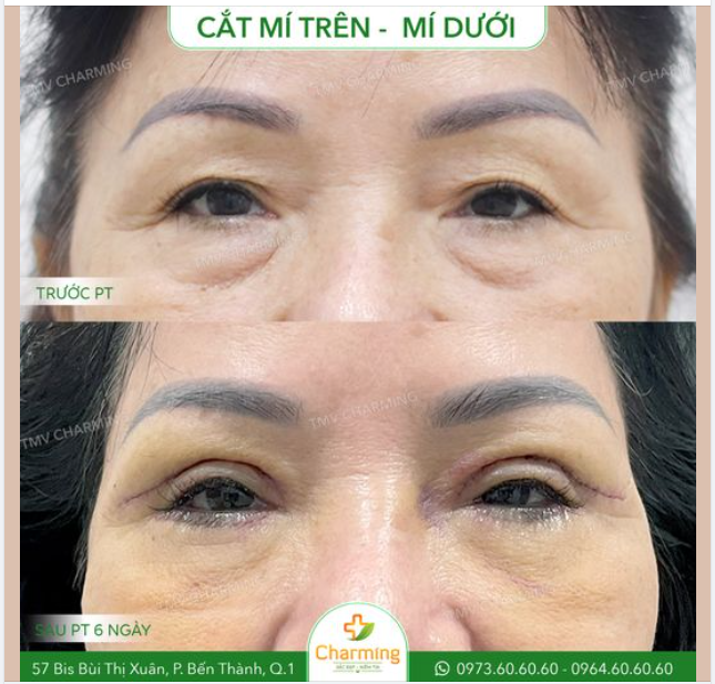 Với đa số những khách lớn tuổi, mí trên lẫn mí dưới đều đã bị tuổi tác làm ảnh hưởng rất nhiều đến diện mạo. Có khi chính vì thế mà nhìn khách còn lớn hơn cả tuổi thật.