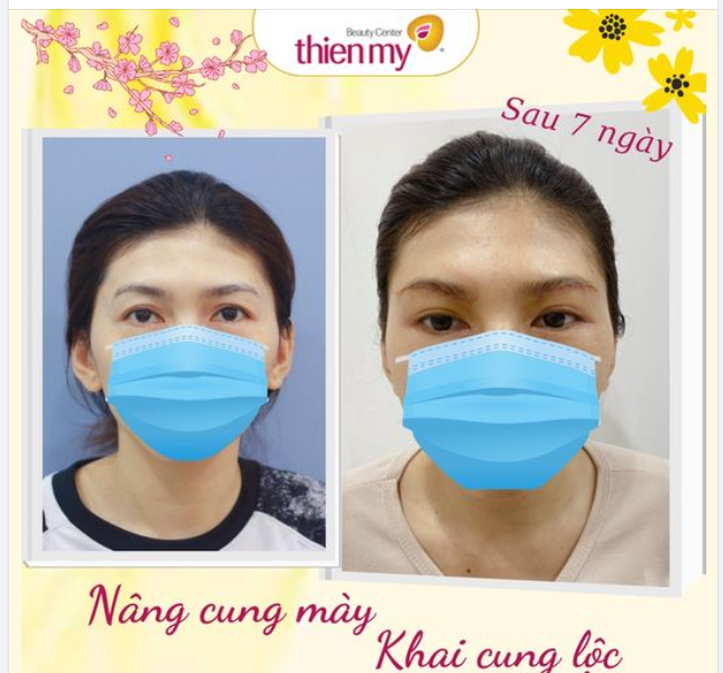 Nâng cung mày - khắc phục tình trạng sụp mí - trẻ hóa đôi mắt