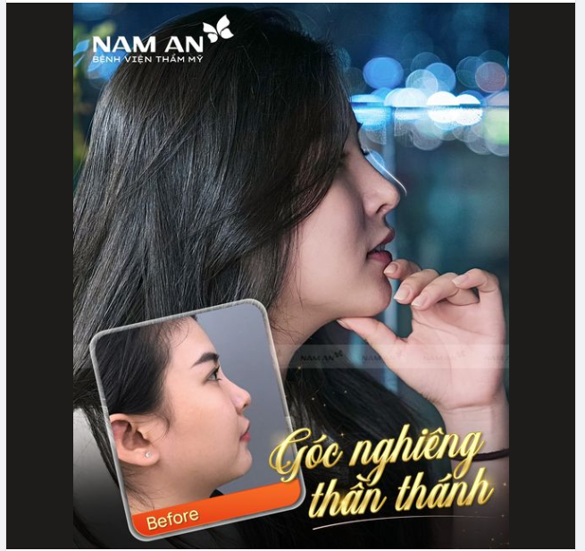 Từng tiêm filler thay đổi thế nào sau khi nâng mũi