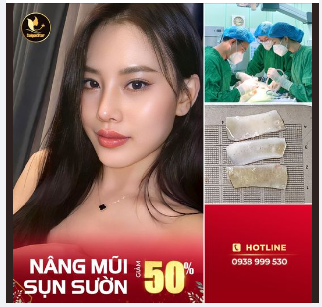 NÂNG MŨI SỤN SƯỜN – GIẢM 50% TRỰC TIẾP BÁC SĨ HOẠT – HƠN 16 NĂM KINH NGHIỆM THỰC HIỆN