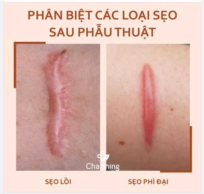 PHÂN BIỆT SẸO LỒI VÀ SẸO PHÌ ĐẠI SAU PHẪU THUẬT