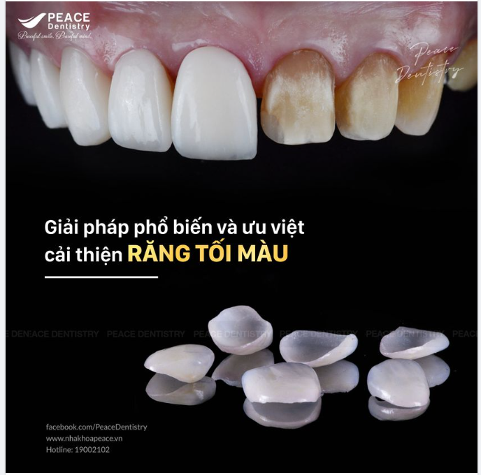 2 LỰA CHỌN ƯU VIỆT VÀ PHỔ BIẾN CHO RĂNG TỐI MÀU