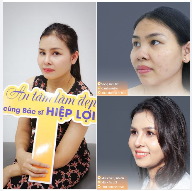Gương mặt cân đối, hài hòa được tạo nên bởi nhiều yếu tố, bao gồm chiếc mũi cao, thanh thoát với phần trán thái dương đầy đặn là chìa khóa cho sự may mắn.