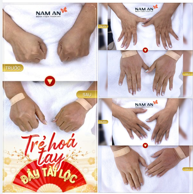 TRẺ HÓA BÀN TAY BẰNG FILLER