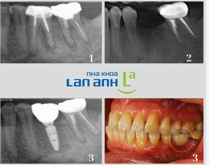Chỉ cần Implant đặt không chính xác, dù nhỏ, thì khi gắn răng sẽ rất khó khăn, và cũng không chịu lực, vệ sinh được dễ dàng.