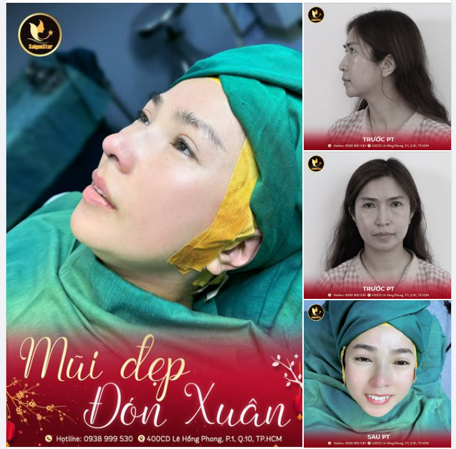 MŨI ĐẸP ĐÓN XUÂN