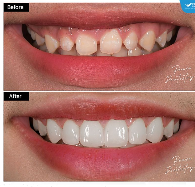 PHẪU THUẬT CẮT NƯỚU  VENEER