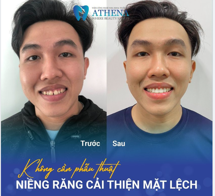 HÔNG CẦN PHẪU THUẬT ​​​​​​​ NIỀNG RĂNG LÀ PHƯƠNG PHÁP CẢI THIỆN MẶT LỆCH NHANH CHÓNG VÀ TIẾT KIỆM CHI PHÍ!