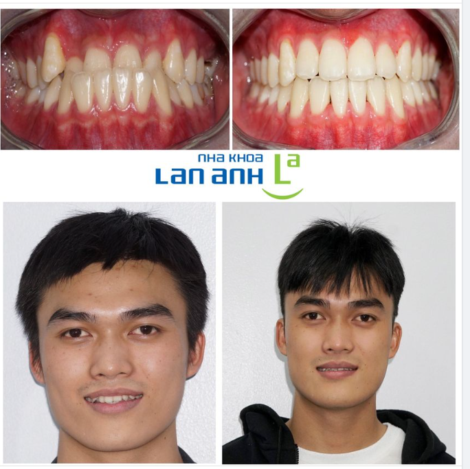 Hình ảnh một trường hợp khách hàng có khớp cắn hạng 3, răng hàm trên chen chúc. Sau điều trị, xếp đều răng, khắc phục cắn ngược, khớp cắn tốt, cải thiện nụ cười.