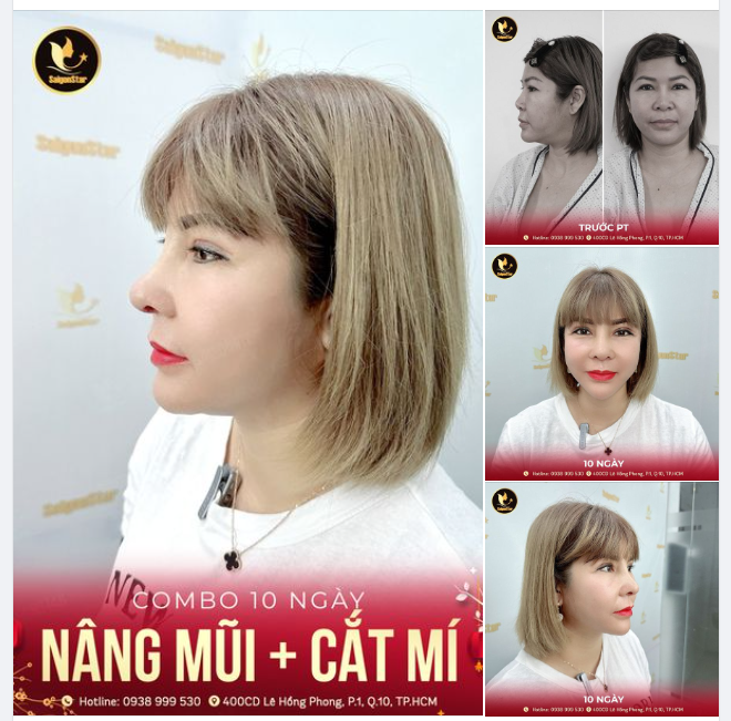 COMBO 10 NGÀY NÂNG MŨI + CẮT MÍ TRẺ ĐẸP – TỰ TIN ĐÓN TẾT
