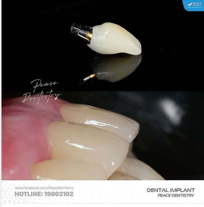 PHỤC HÌNH TRÊN IMPLANT CŨNG ĐÒI HỎI CAO VỀ NĂNG LỰC, TAY NGHỀ CỦA BÁC SĨ
