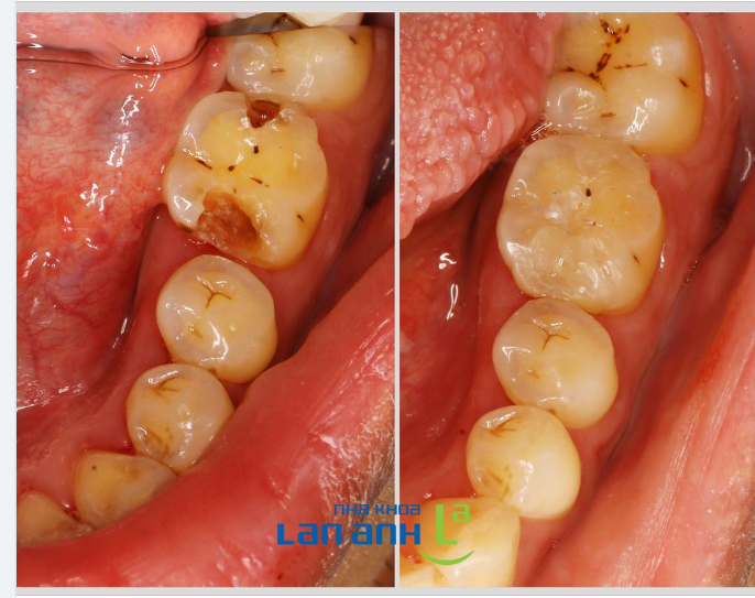 Sử dụng miếng trám sứ Inlay/Onlay là lựa chọn hoàn hảo cho một số trường hợp răng bị sâu, bể, hoặc vỡ.