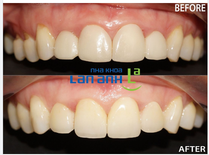 Một trường hợp phục hình 4 răng sứ Cercon của bác sĩ Lan - CN Tôn Dật Tiên, Phường Tân Phong, Quận 7.