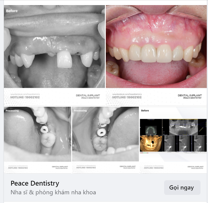 IMPLANT  GHÉP XƯƠNG  GHÉP NƯỚU